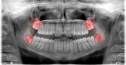 Czy ósemki rosną na górze? Odkryj prawdę o zębach mądrości