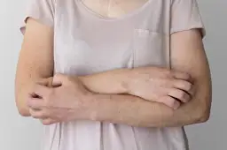 Objawy skórne nerwicy: Czy Twój lęk widać na skórze? Leczenie