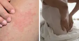 Dwa obrazy: wysypka na skórze i osoba trzymająca się za plecy.