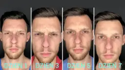 Kiedy efekty po botoksie? Od 2 dni do 6 miesięcy pełen harmonogram