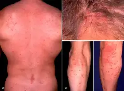 Morbus Duhring Diagnostik: Wichtige Tests und Verfahren zur sicheren Diagnose