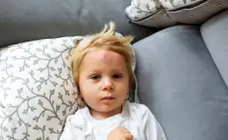 Mały chłopiec z blond włosami leży na kanapie z widocznym guzem na czole po mocnym uderzeniu w głowę.