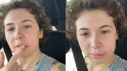 Jak zmniejszyć zaczerwienienie pryszcza? Moje szybkie triki!