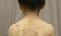 Czy dziecko ze strupami po ospie może iść do przedszkola? Ważne zasady i zalecenia