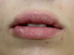 Palenie po powiększaniu ust: Bezwzględny zakaz! Co musisz wiedzieć?