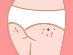 Jak pozbyć się pryszczy na pośladkach - skuteczne metody i porady