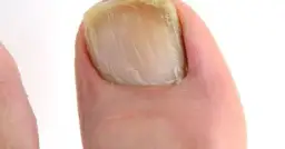 Skuteczne leczenie grzybicy paznokci: Co działa naprawdę?