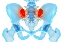 Jakie leczenie i lekarz przy zapaleniu stawu krzyżowo-biodrowego?