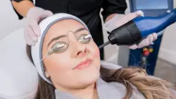 Kobieta w okularach ochronnych poddaje się zabiegowi laserem frakcyjnym na twarz.