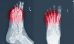 Skręcenie śródstopia objawy - jak rozpoznać ból i obrzęk stopy