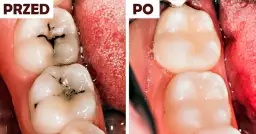 Domowe sposoby na próchnicę: co działa, a kiedy musisz iść do dentysty?