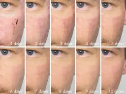 Jak wygląda twarz po laserze frakcyjnym? Efekty i objawy po zabiegu