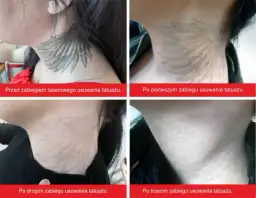 Jak rozjaśnić tatuaż skutecznie i bezpiecznie – poznaj metody