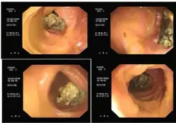 Niepokojące Objawy Po Operacji Przepukliny - Kiedy Szukać Pomocy