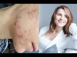 Gładka cera bez pryszczy: Poznaj sprawdzony plan Ewy Michalskiej