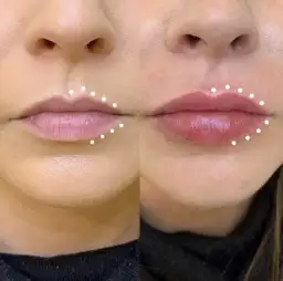 Najlepsze kliniki w Warszawie na zabiegi z kwasem hialuronowym