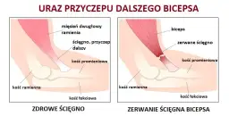 Naderwany biceps - objawy, które powinny cię zaniepokoić