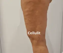 Co wam pomogło na cellulit? Skuteczne metody, które działają