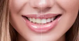 Skuteczne metody na wybielenie zębów w domu – uniknij problemów