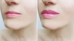 Botoks na usta: 3-4 miesiące? Sprawdź, co wpływa na trwałość!