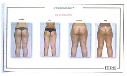 Endermologia: Czy warto inwestować? Efekty, koszty, wady