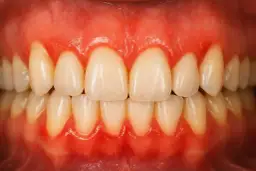 Co na zapalenie dziąseł w ciąży? Skuteczne i bezpieczne metody