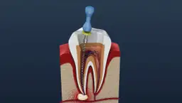 Zatruty ząb: nie czekaj! Ryzyko sepsy i pilna pomoc