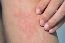 Masz krostki na nogach? Oto przyczyny i jak mieć gładką skórę