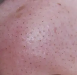 Jak wygląda zapchana cera i jak skutecznie z nią walczyć