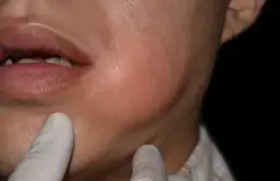 Ropa w dziąśle objawy: Jak rozpoznać i uniknąć powikłań?