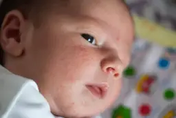 Potówki u niemowląt: Jak szybko ulżyć i skutecznie zapobiegać?