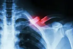 Ile trwa rehabilitacja po złamaniu obojczyka i jak uniknąć bólu?