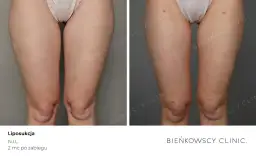 Czy liposukcja jest bezpieczna? Klucz do minimalizacji ryzyka