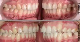 Czy aparat ortodontyczny zmieni Twoją twarz? Rozwiewamy mity!