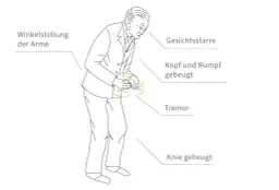 Diagnostik Parkinson Krankheit: So erkennen Sie die Symptome rechtzeitig