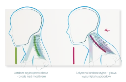 Ilustracja porównuje prawidłową lordozę szyjną z jej zniesieniem. Po prawej, zniesiona lordoza szyjna powoduje wysunięcie głowy do przodu.