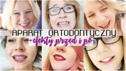 Aparat ortodontyczny a usta: Iluzja czy realna zmiana?