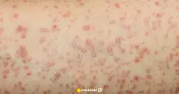 Liszaj płaski w ustach: objawy, przyczyny, leczenie i domowe sposoby