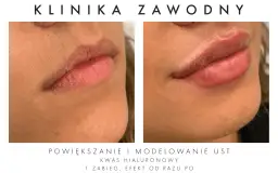 Kwas hialuronowy na usta: Nawilżenie czy powiększanie? Poznaj prawdę