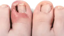 Wrastający paznokieć: Jak obciąć bezpiecznie i kiedy do podologa?