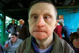 Jak długo żyją osoby z zespołem Downa? Zaskakujące statystyki życia