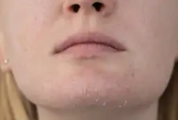 Ile goi się strup po pryszczu? Unikaj błędów w pielęgnacji skóry