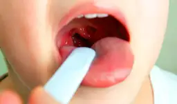 Paciorkowiec w gardle objawy: Jak rozpoznać i uniknąć bólu?