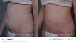 Liposukcja: Co to? Metody, efekty, rekonwalescencja. Czy to dla Ciebie?