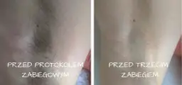Ile zabiegów depilacji SHR potrzebujesz dla trwałych efektów?