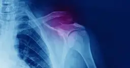 RTG barku z widocznym złamaniem obojczyka, zaznaczonym na fioletowo.