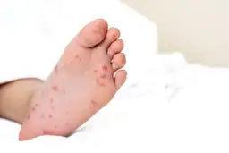 Czerwone stopy u dziecka: kiedy martwić się i iść do lekarza?