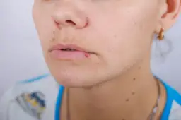 Opryszczka czy pryszcz: jak je odróżnić i uniknąć pomyłek