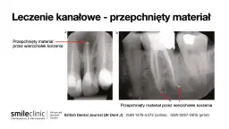 Ból po leczeniu kanałowym: normalny czy alarm? Oś czasu gojenia