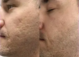 Laser frakcyjny nieablacyjny: Czy to najlepsza inwestycja w skórę?